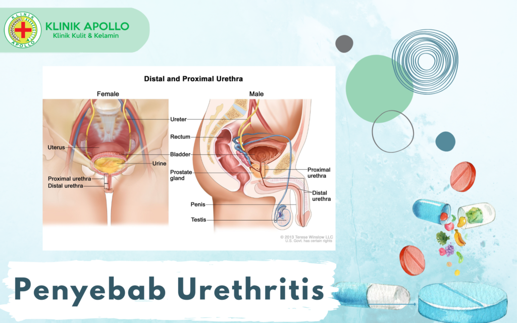 Ketahui Penyebab Urethritis 